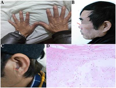 Bronchoscopy-Guided Intervention Therapy With Extracorporeal Membrane Oxygenation Support for Relapsing Polychondritis With Severe Tracheobronchomalacia: A Case Report and Literature Review